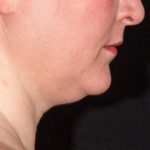 Warmsculpting Before & After Patient #252