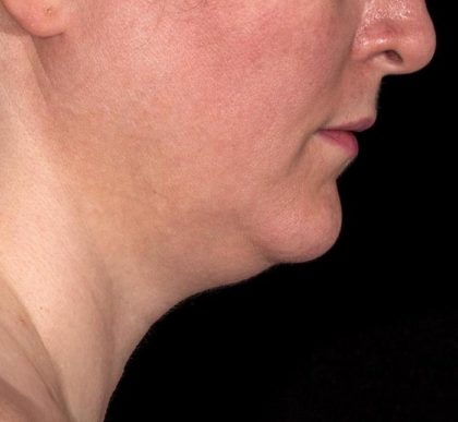 Warmsculpting Before & After Patient #252