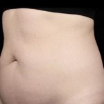 Warmsculpting Before & After Patient #255