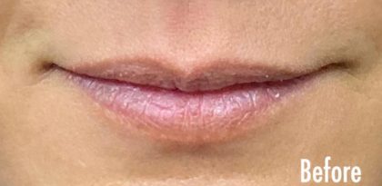Lip Fillers Before & After Patient #240