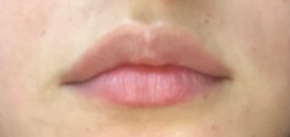 Lip Fillers Before & After Patient #291