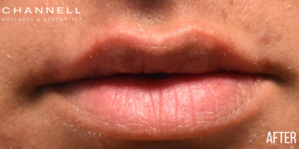 Lip Fillers Before & After Patient #351