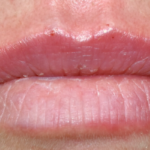 Lip Fillers Before & After Patient #354