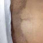 Scar Removal Before & After Patient #400