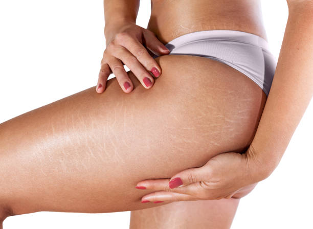 stretch mark removal rancho cucamonga