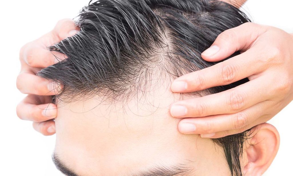 Hair Restoration Treatment Programs